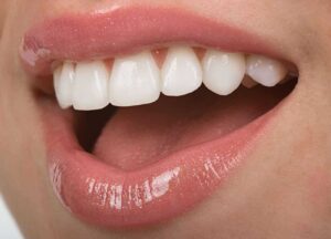 Weiße Flecken nach dem Bleaching auf den Zähnen Titelbild