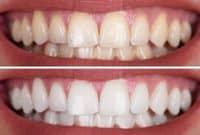 Zahnaufhellung Zähne