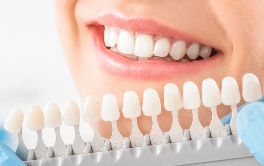Bleaching: Wege zu attraktiven weißen Zähnen